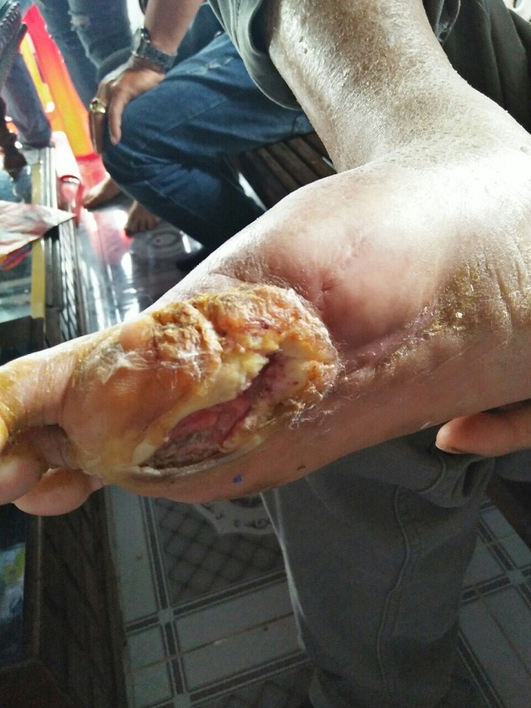 Bài thuốc chữa hiệu quả bệnh Suy giãn tĩnh mạch, động mạch – Lương y Bùi Xuân Qùy