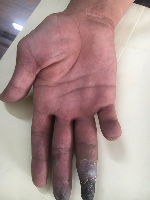 Bài thuốc chữa hiệu quả bệnh Suy giãn tĩnh mạch, động mạch – Lương y Bùi Xuân Qùy