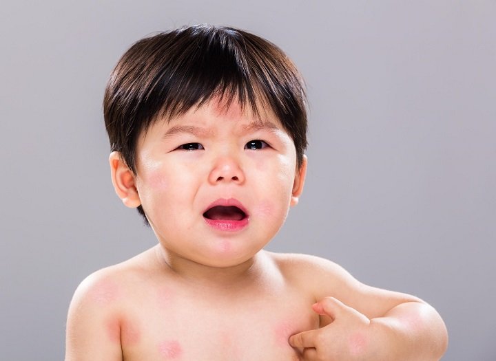 Dấu hiệu bé bị dị ứng thịt vịt cha mẹ không nên bỏ qua
